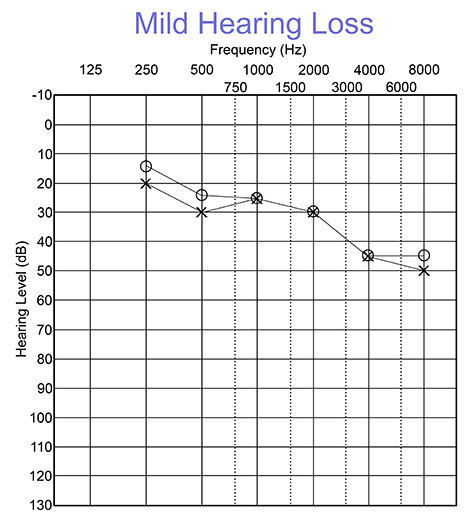 Audiogram with mild hearing loss