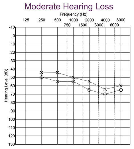 Audiogram with moderate hearing loss