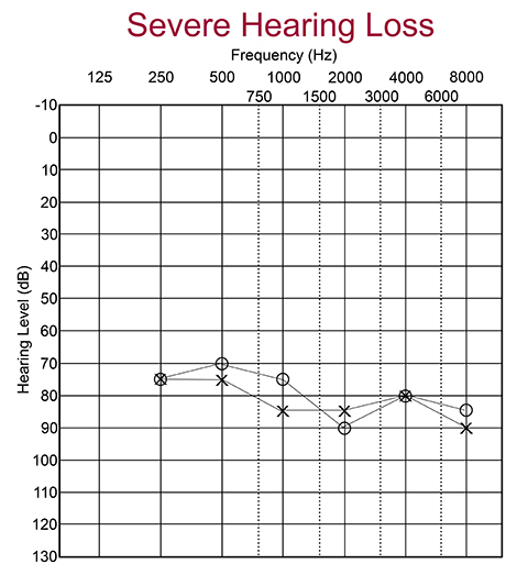 Audiogram with severe hearing loss
